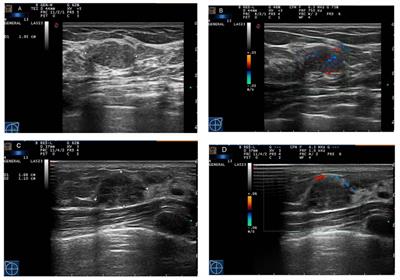 An integrated radiomics nomogram based on conventional ultrasound improves discriminability between fibroadenoma and pure mucinous carcinoma in breast